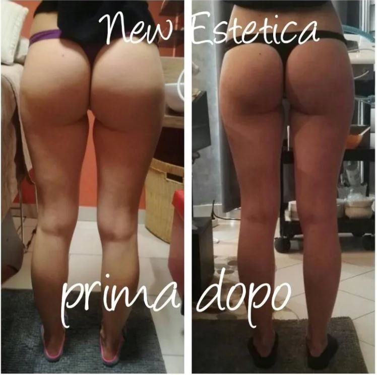 Trattamento glutei prima e dopo