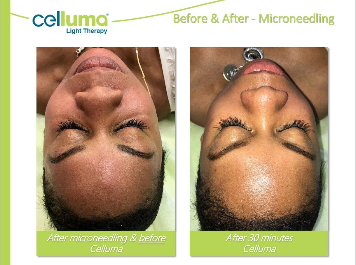 Before and after comparison of a person's face after microneedling and Celluma light therapy.