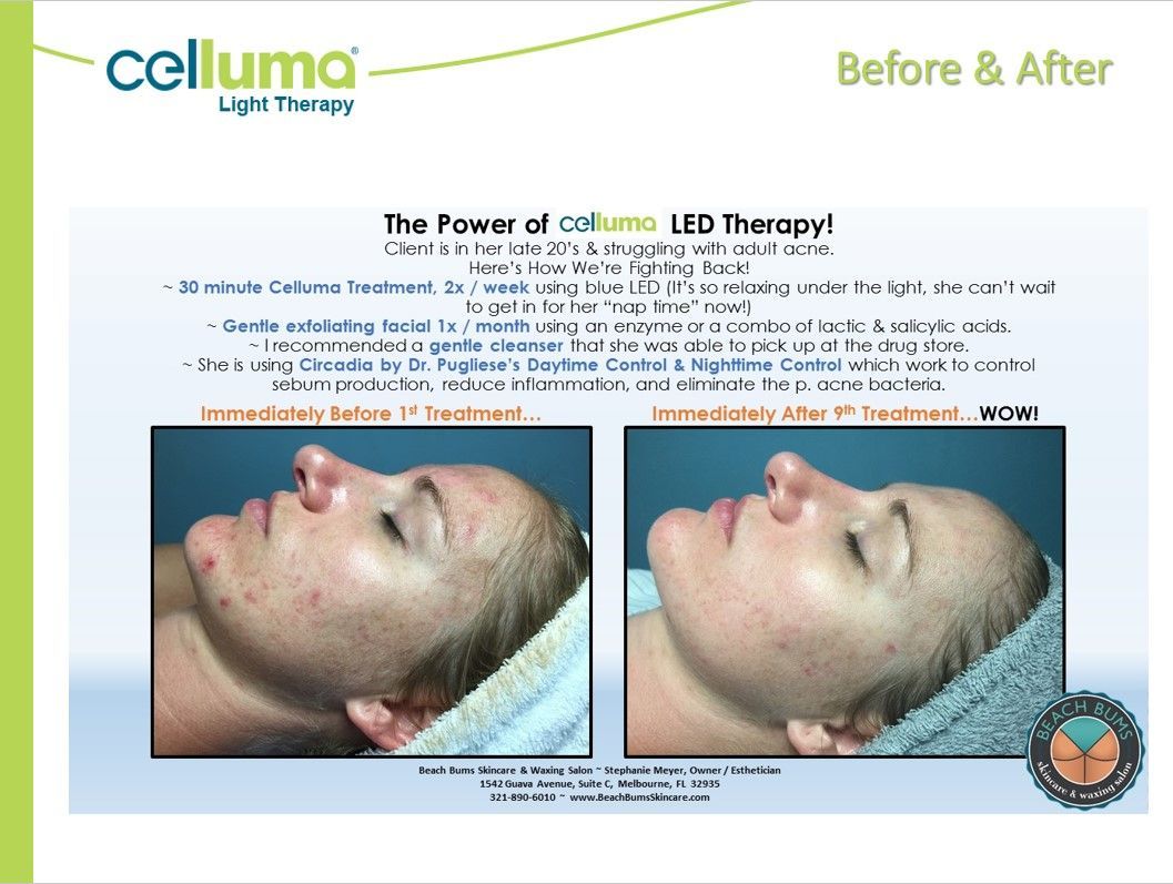 Side-by-side comparison of a person's face showing reduction in acne after Celluma LED therapy.