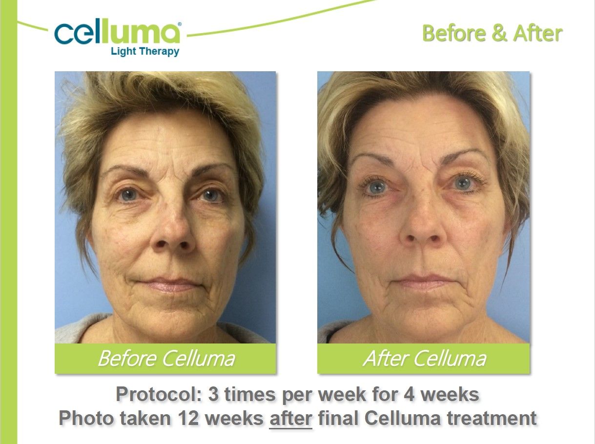 Side-by-side photos show a woman before and after Celluma light therapy treatment, with a reduction in wrinkles.
