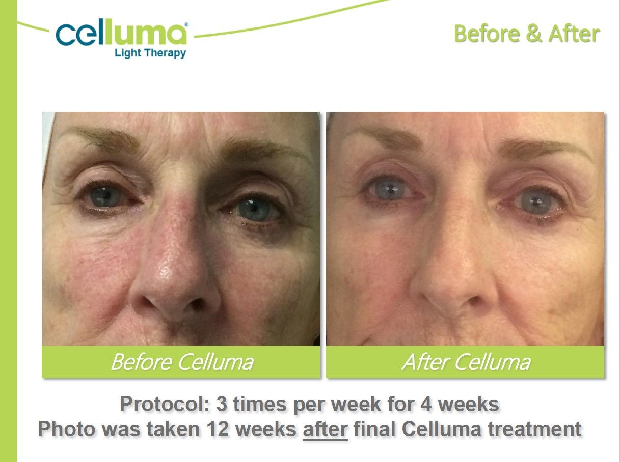 Before and after comparison of woman's face. Left side: before Celluma treatment. Right side: after treatment.