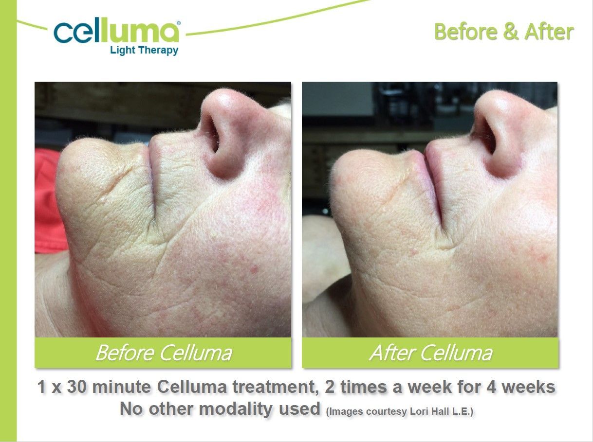 Side-by-side comparison: before & after Celluma light therapy treatment on a face, showing reduced wrinkles.