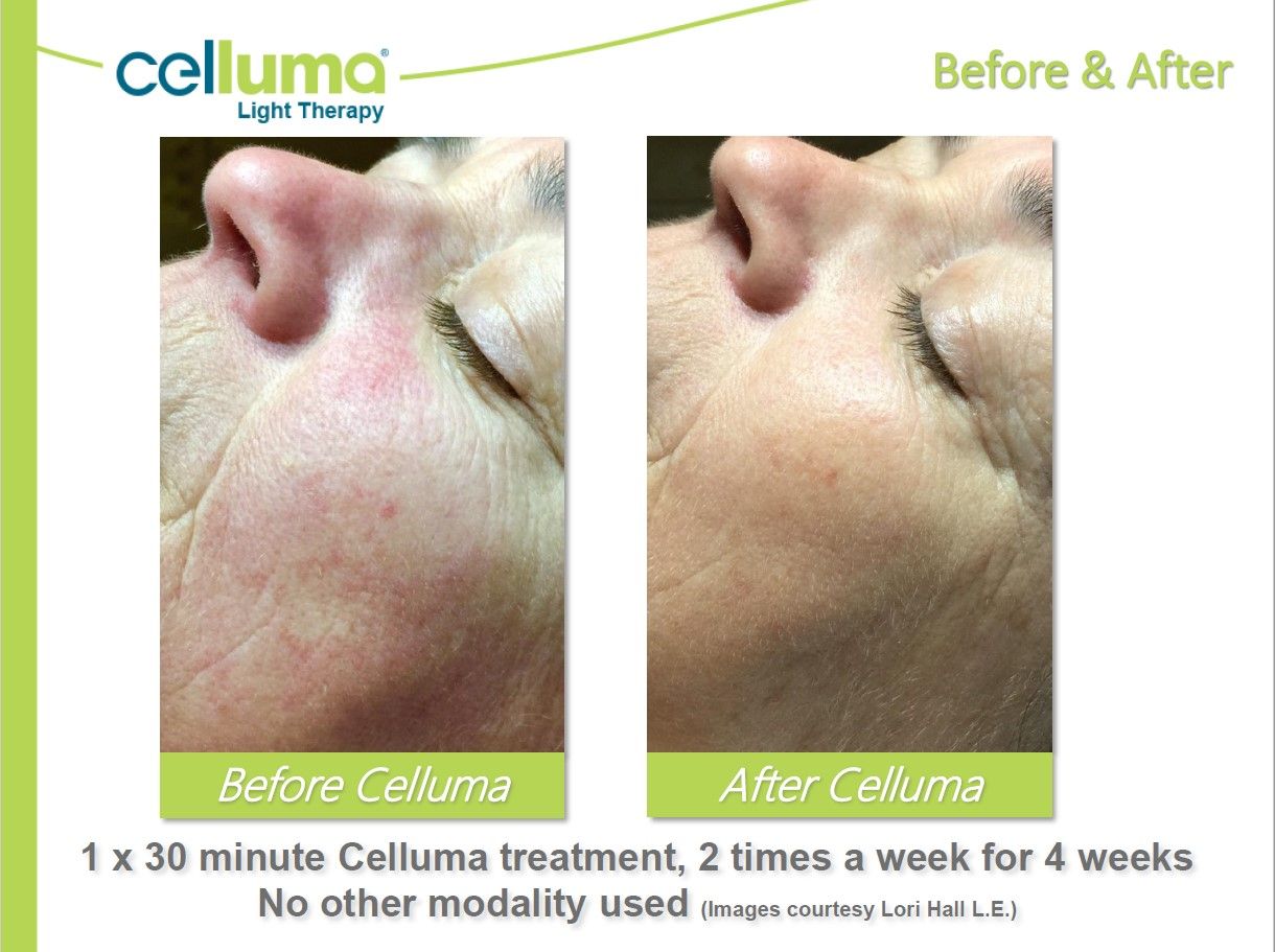 Before & after comparison showing facial skin improvement after Celluma light therapy treatment.