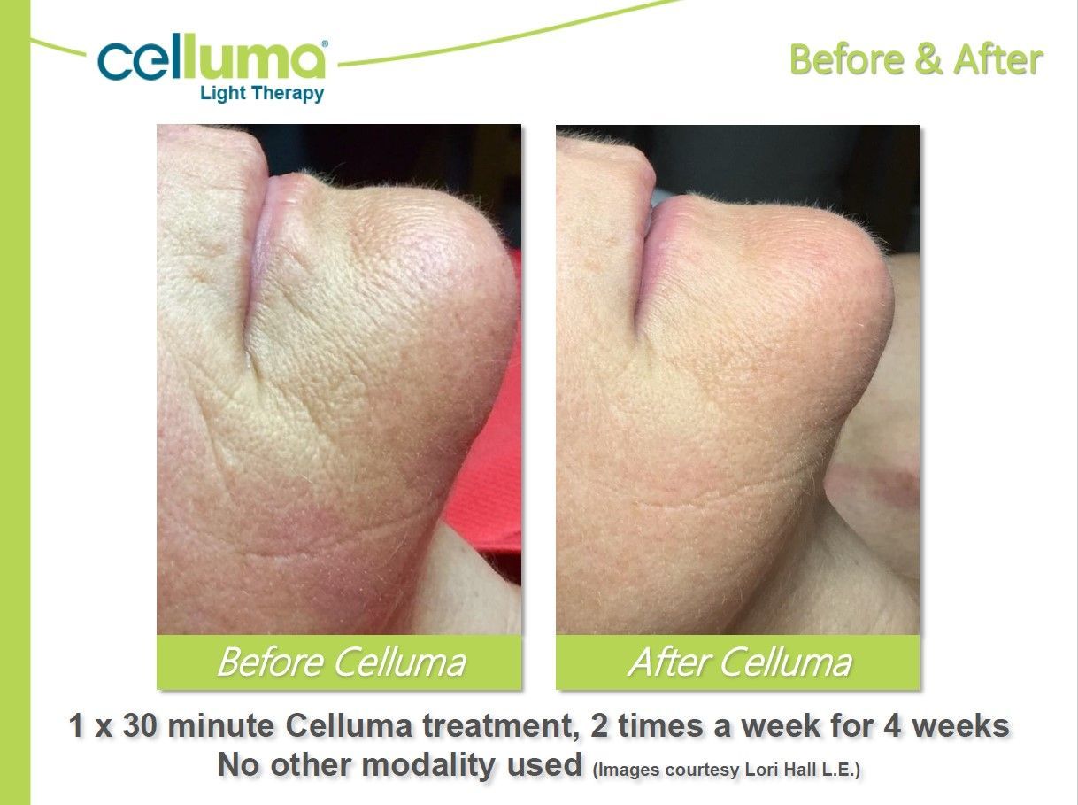 Side-by-side comparison of a chin before and after Celluma light therapy treatment, showing reduced wrinkles.
