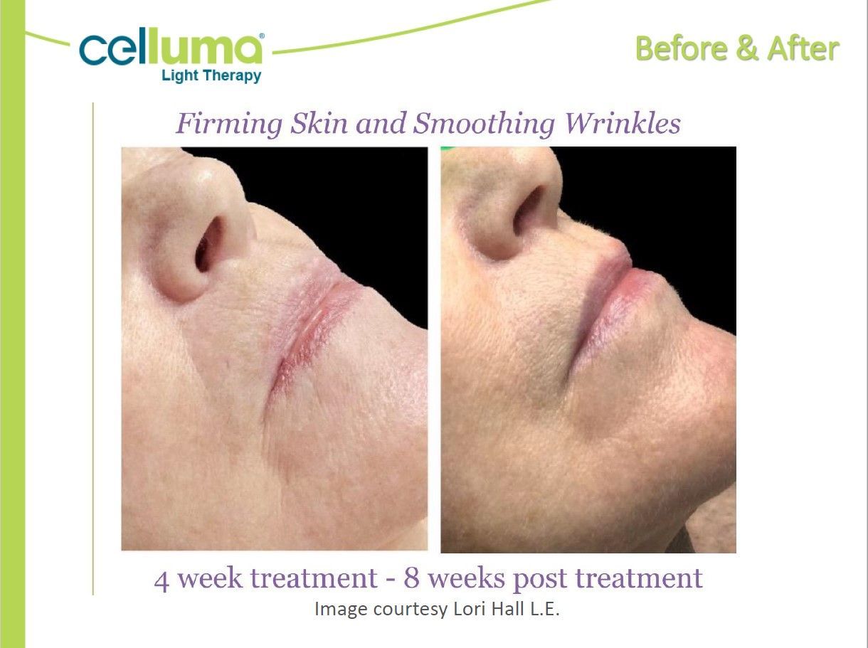Celluma Light Therapy before & after: skin firming & wrinkle reduction.  Left shows red line; right, smoother skin.