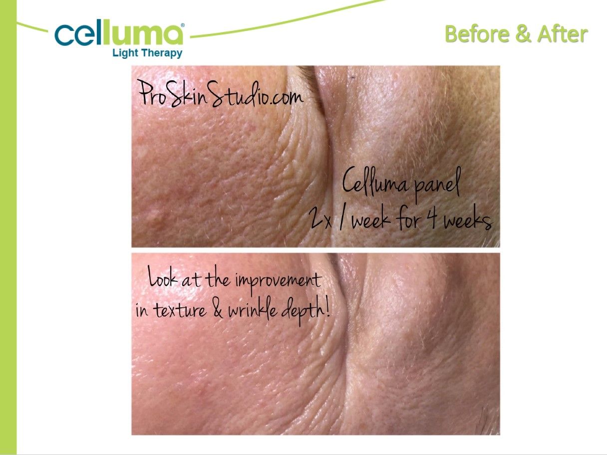 Before and after skin texture comparison. Celluma light therapy results after four weeks.