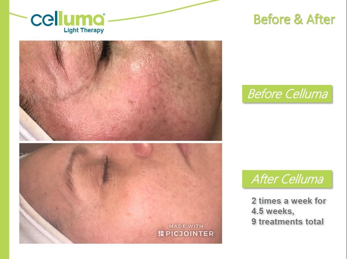 Side-by-side comparison shows skin before & after Celluma light therapy, with a reduction in redness and wrinkles.