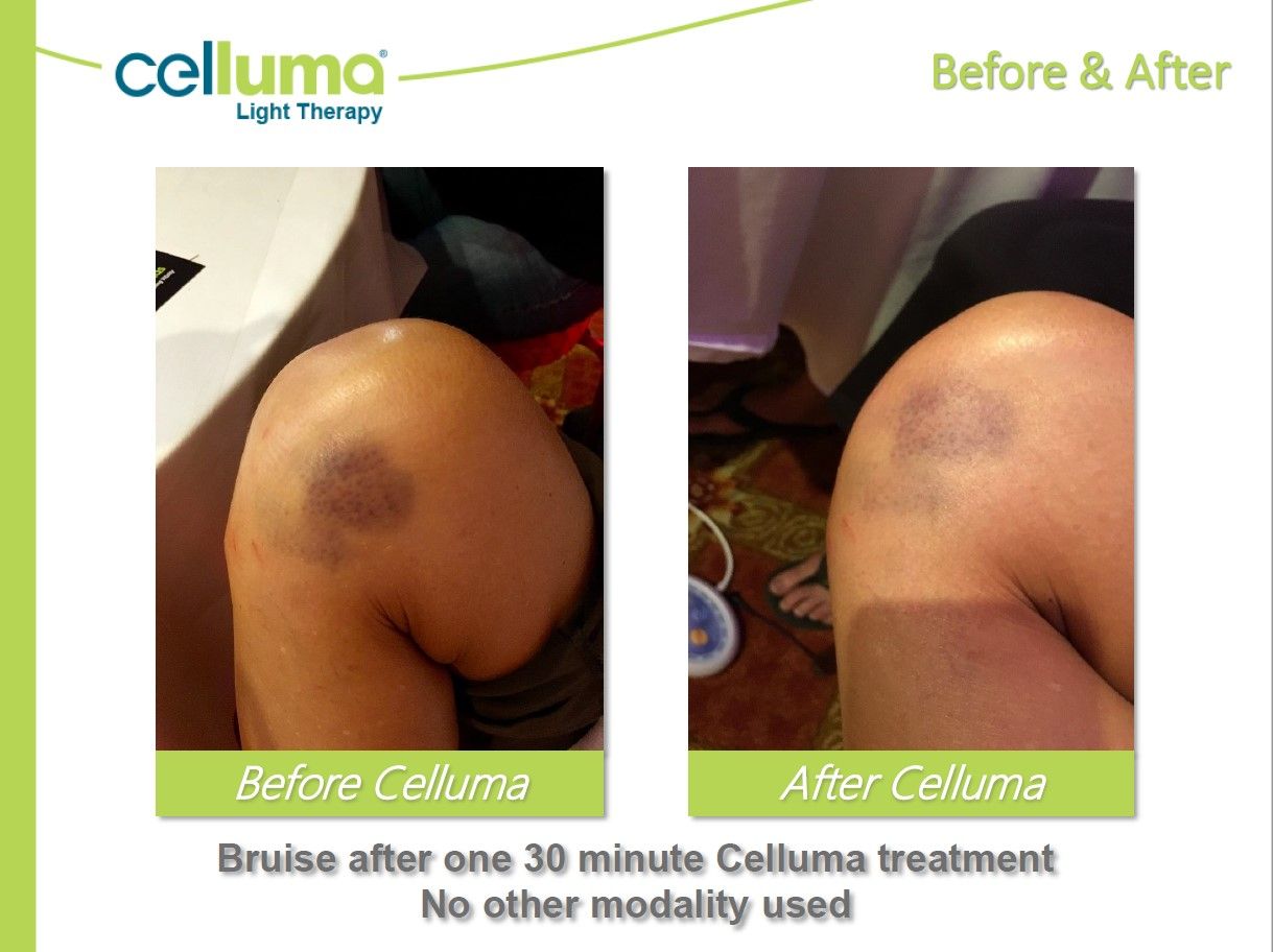 Comparison of a bruised knee before and after Celluma light therapy treatment.