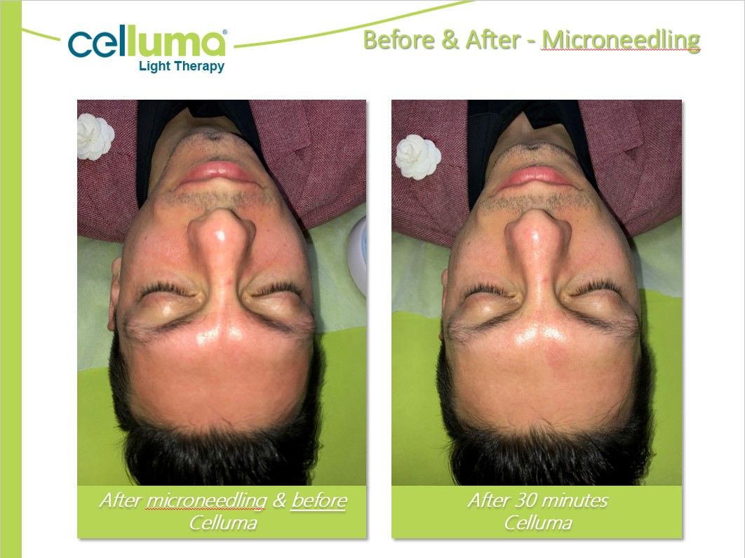 Side-by-side comparison of a person's face before and after microneedling, showing redness.