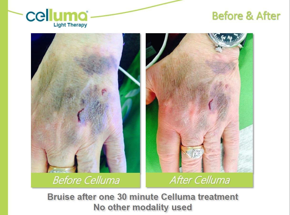 Comparison of a bruised hand before and after Celluma light therapy treatment.