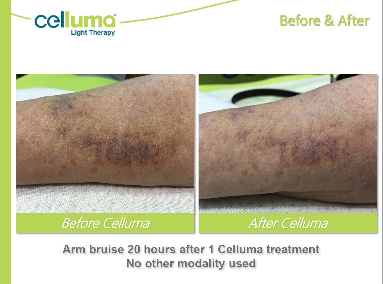 Arm with bruise, before and after Celluma light therapy treatment, 20 hours apart.