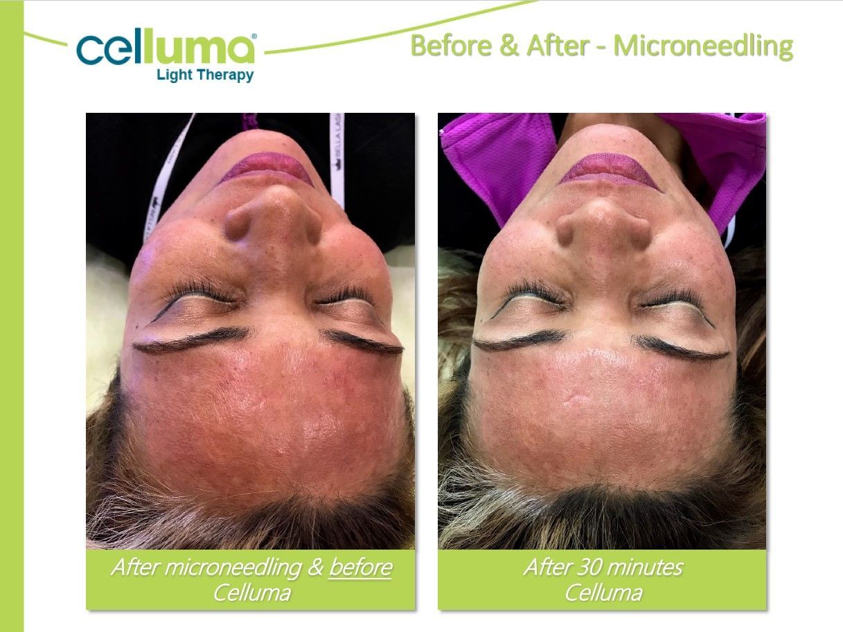Side-by-side comparison of a woman's face before and after Celluma light therapy following microneedling.