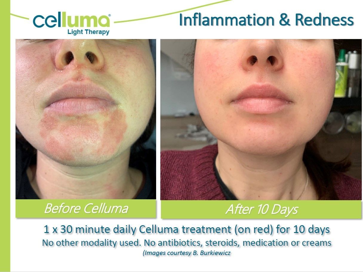 Comparison of a person's face before and after Celluma light therapy treatment for inflammation and redness.