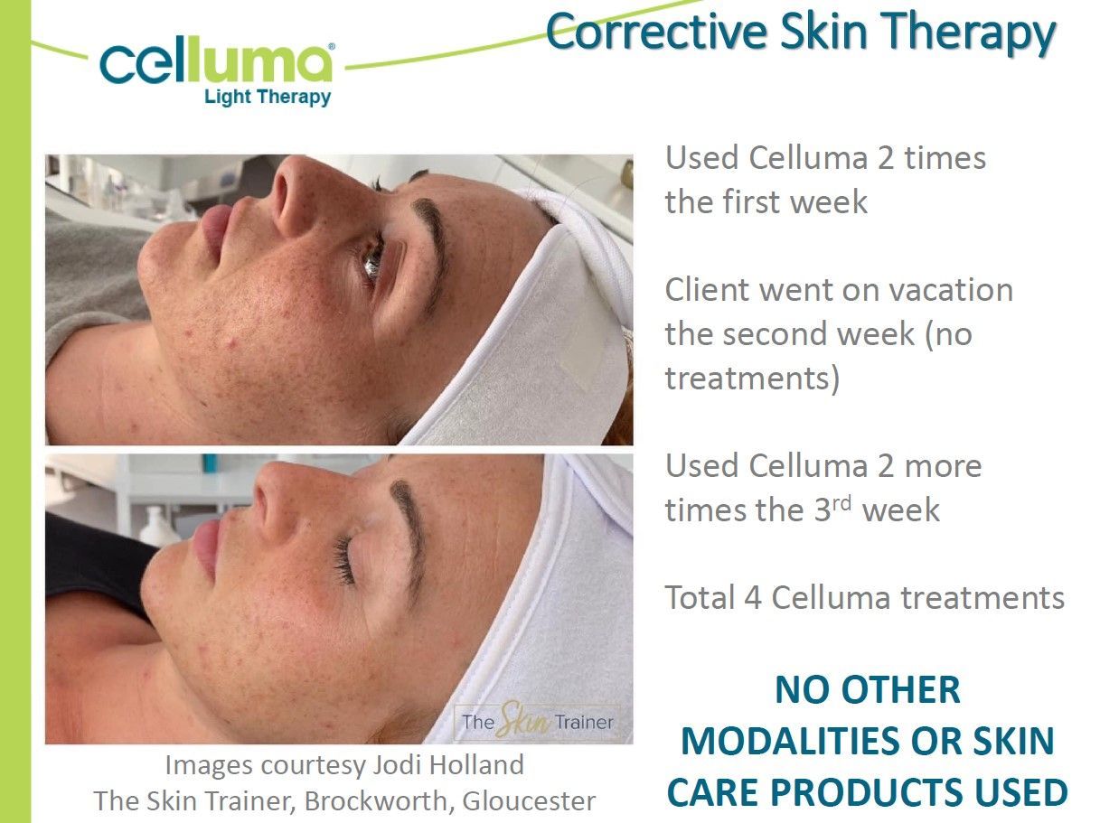 Before and after photos of a person's face; celluma light therapy results.