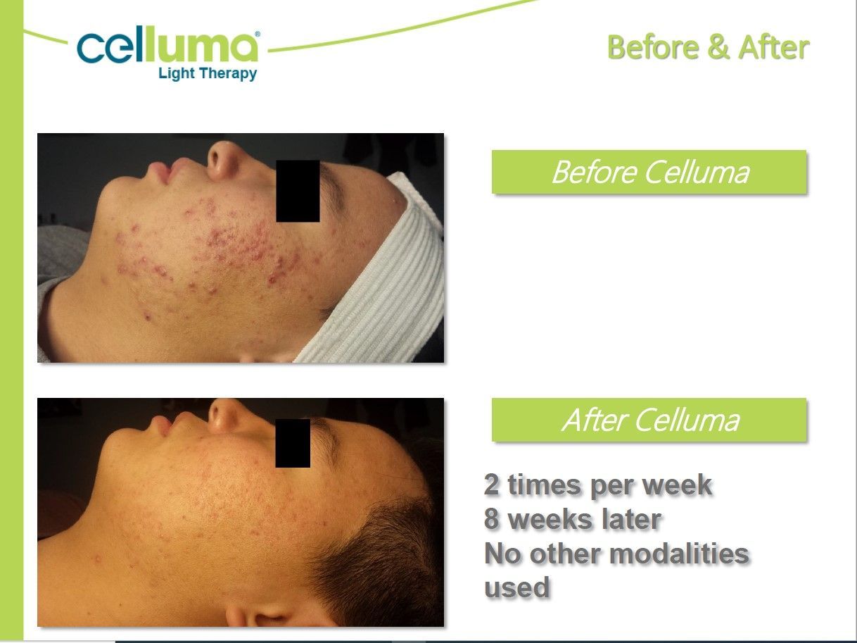 Side-by-side comparison shows acne before and after Celluma light therapy treatment on a person's face.