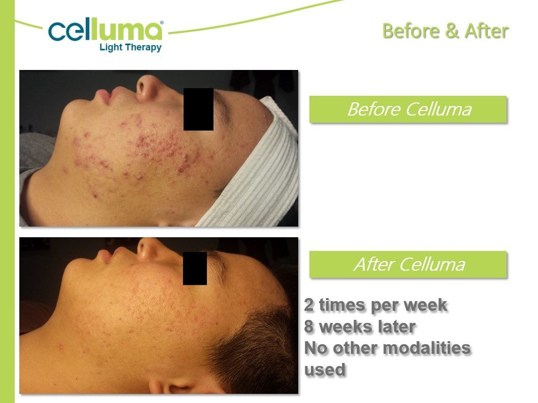 Comparison of a person's face before and after Celluma light therapy treatment, showing acne reduction.