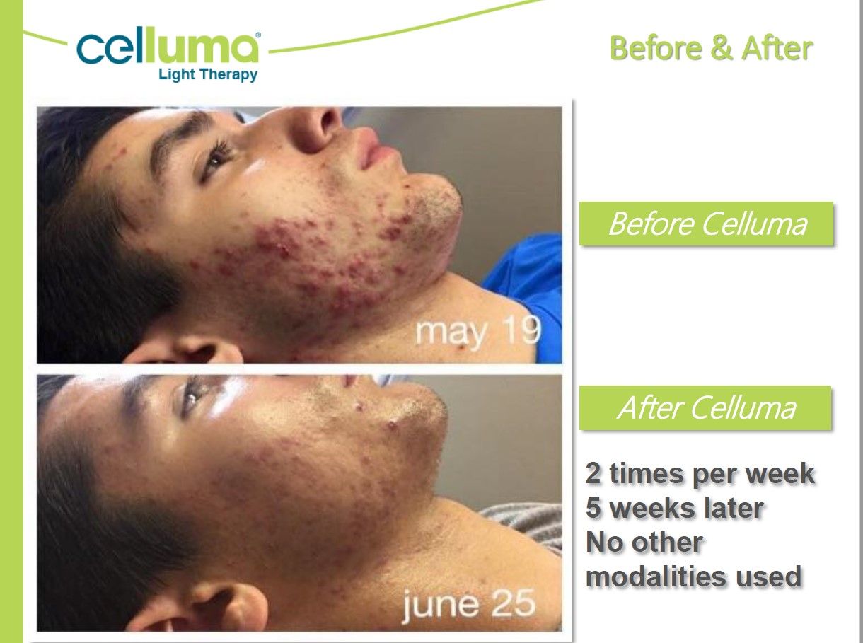 Comparison of a person's acne before and after Celluma light therapy treatment.