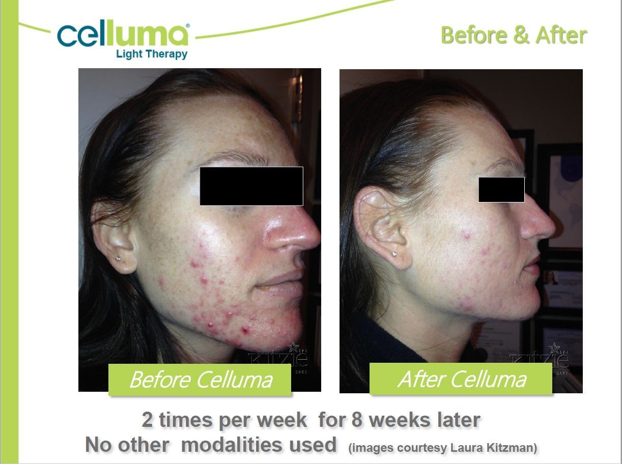 Side-by-side comparison shows acne improvement after Celluma light therapy, before and after 8 weeks.