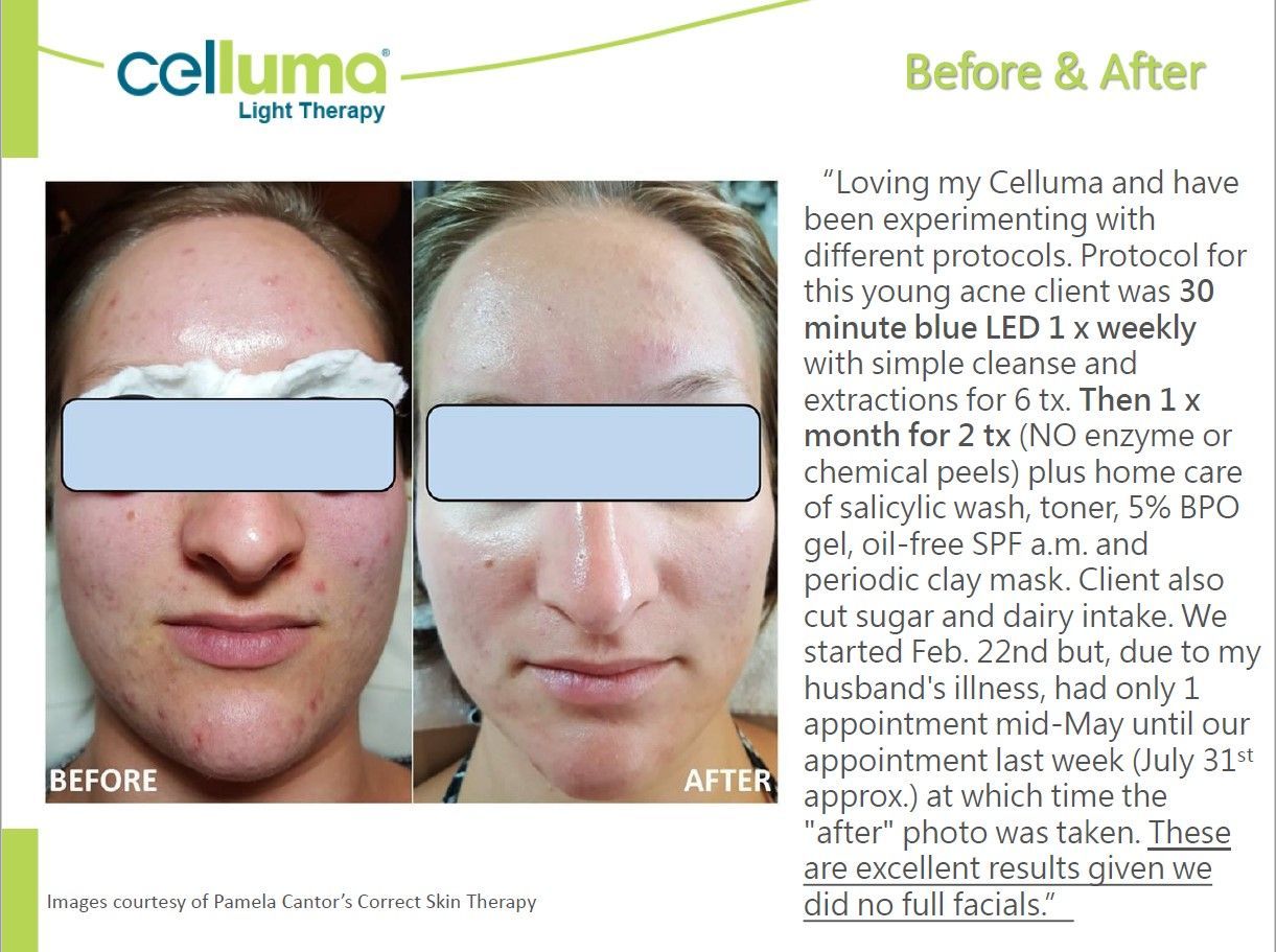 Before and after photos showing facial skin improvement. Text explains a treatment using LED light and skincare.