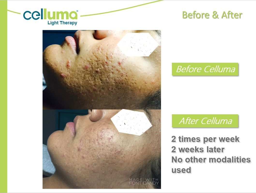 Comparison of skin before and after Celluma light therapy treatment, showing improvement in acne scars after two weeks.