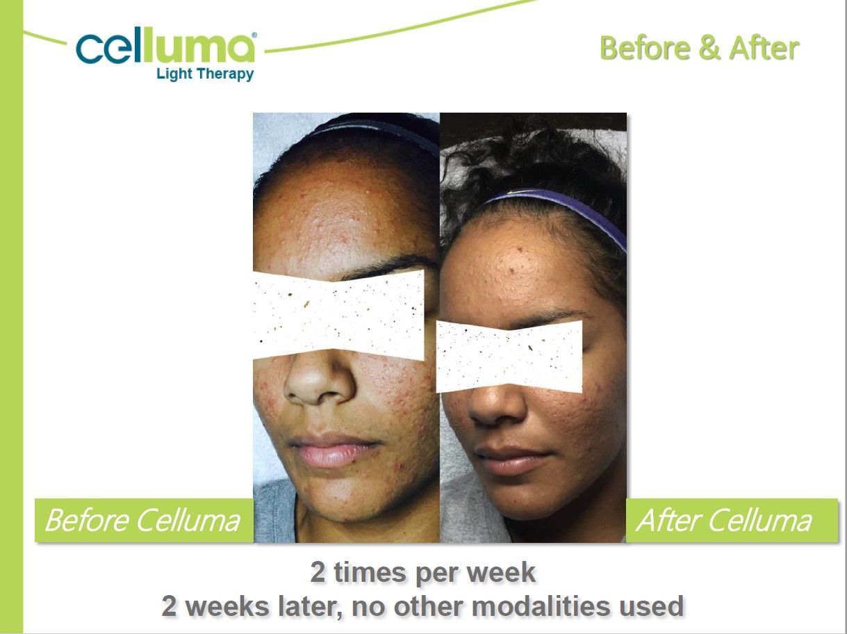 Before-and-after of a person's face. Left side: before Celluma. Right side: after Celluma light therapy treatment.