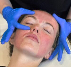 Woman with red skin undergoing a facial treatment, hands in blue gloves touch her face.