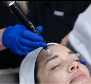 Person receiving microneedling treatment on the forehead; blue-gloved hand holds a pen-like device.