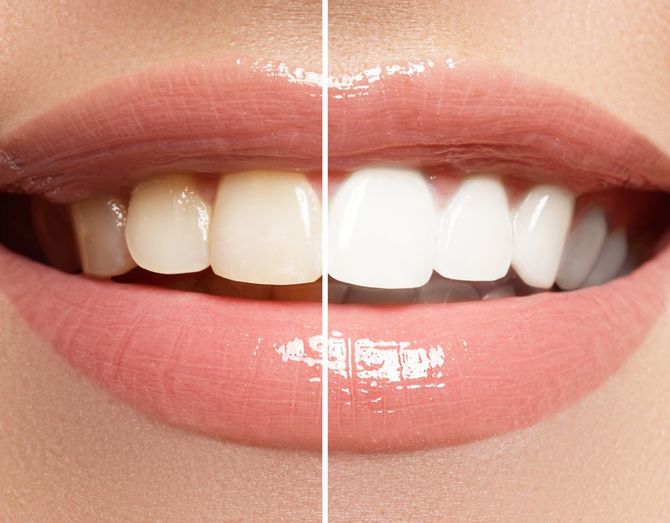 teeth whitening