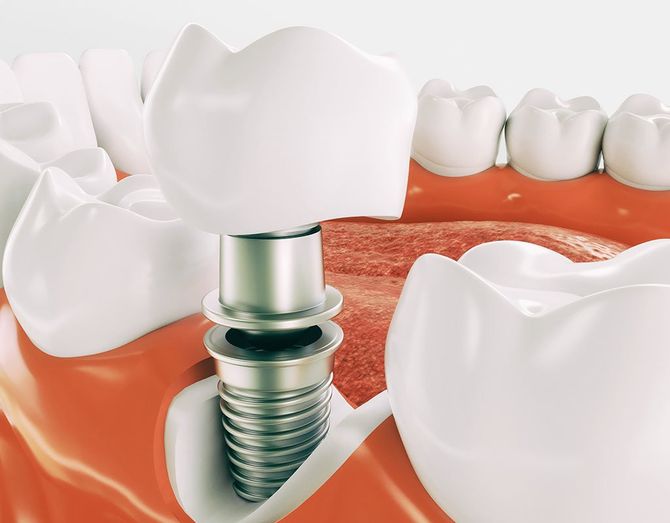 dental implant