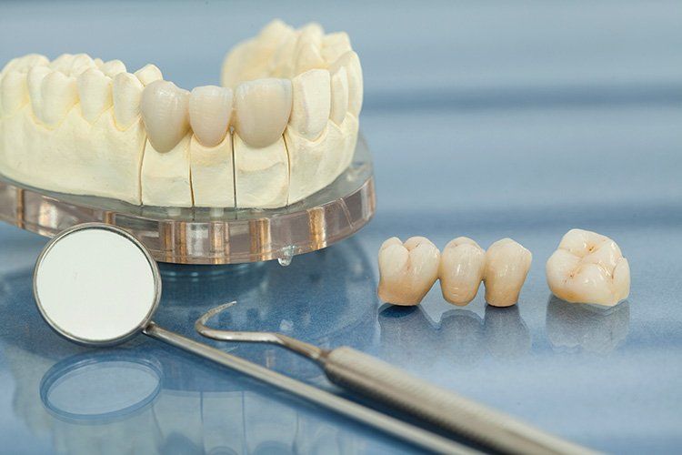 Dental bridge and dentist equipment