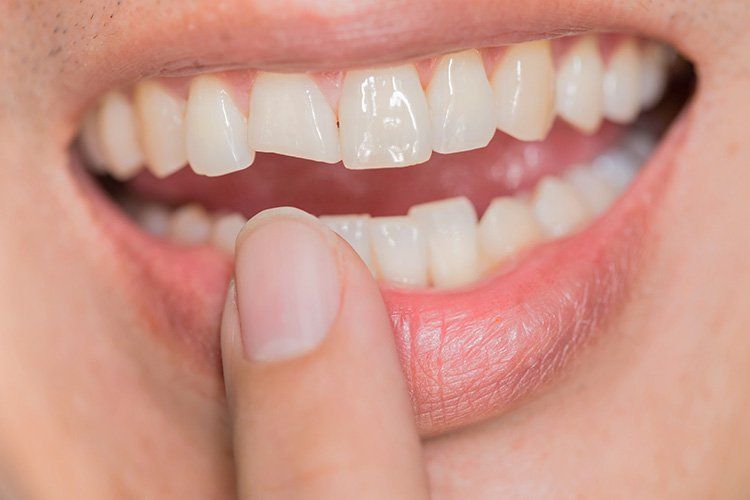 Close up of woman's chipped tooth.