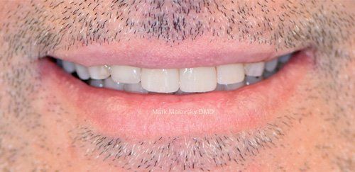 Close up photo of mans teeth before dental procedure