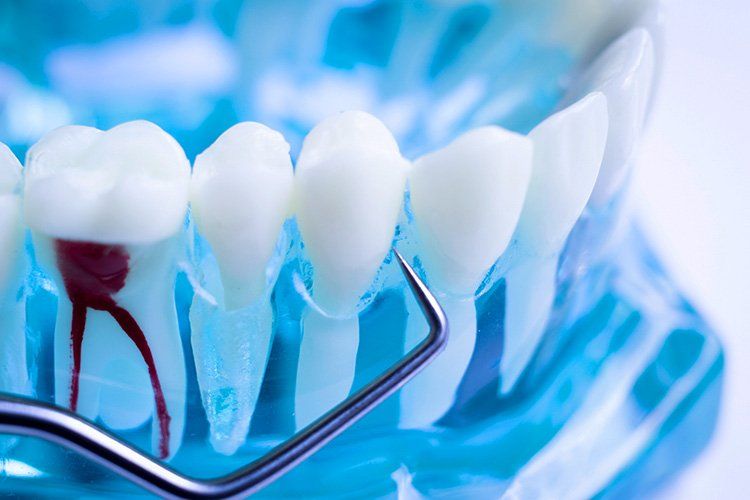 Illustration of a root canal