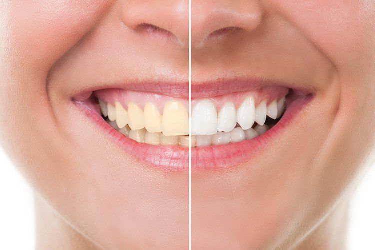 Image of woman's before and after teeth whitening