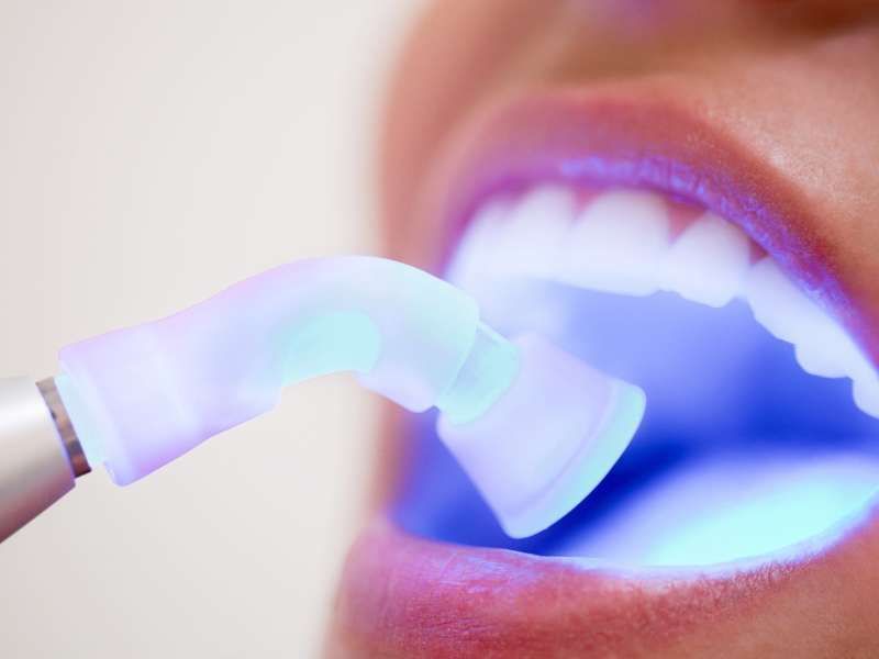 Dental Periodontal Laser