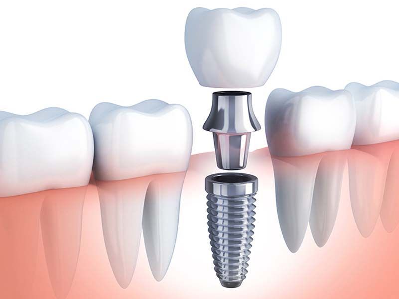 How Dental_Implants Work