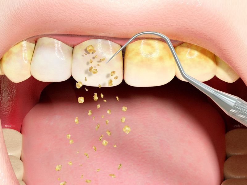 Traditional Dental Implants – Like Natural Teeth