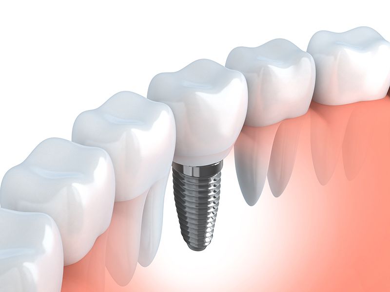 Traditional Dental Implants – Like Natural Teeth
