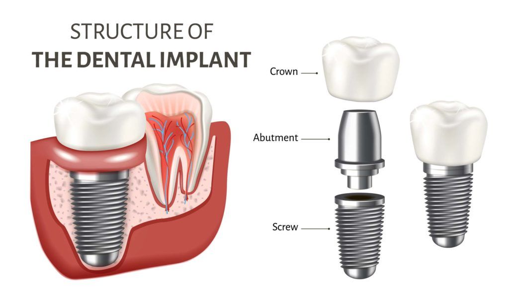 The Structure of a Dental Implant