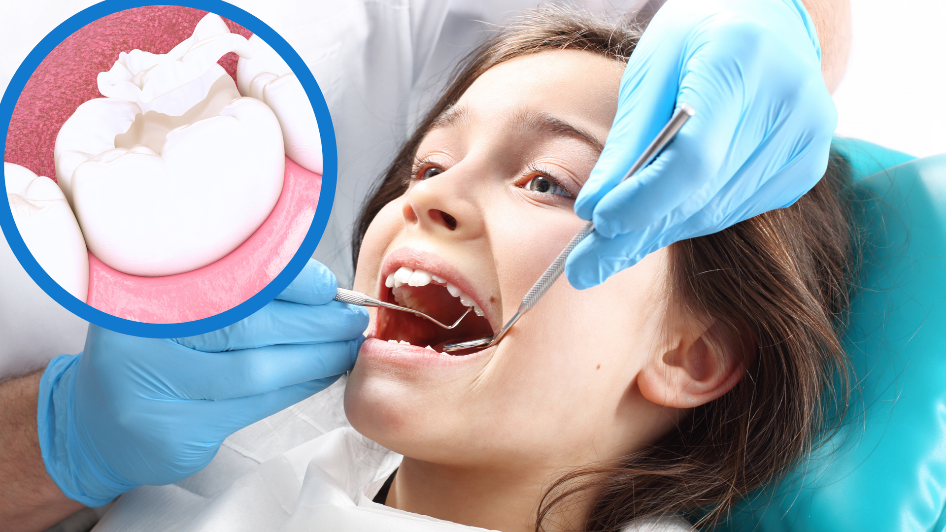 dental sealants for kids