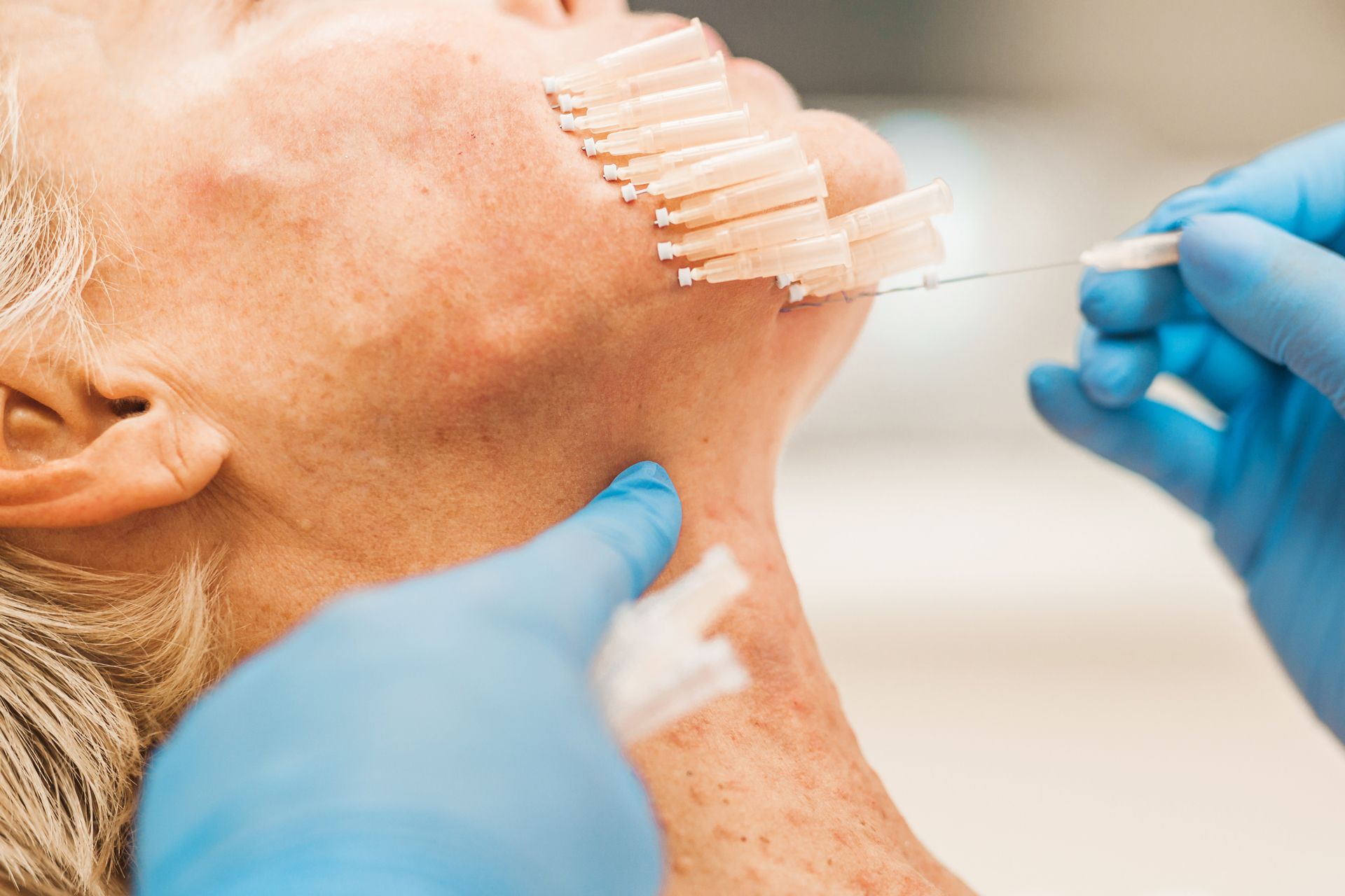 Person receiving medical procedure on neck, with sutures and gloved hands visible.