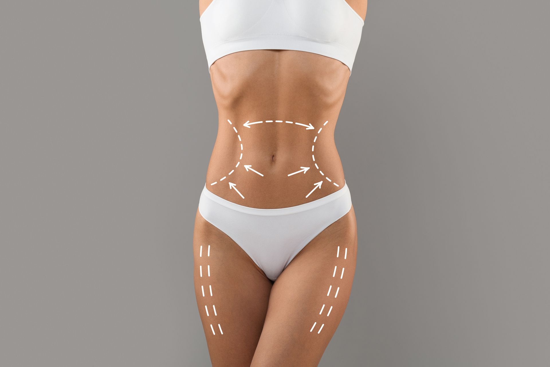 Woman in white underwear with dotted lines and arrows indicating areas for cosmetic surgery.