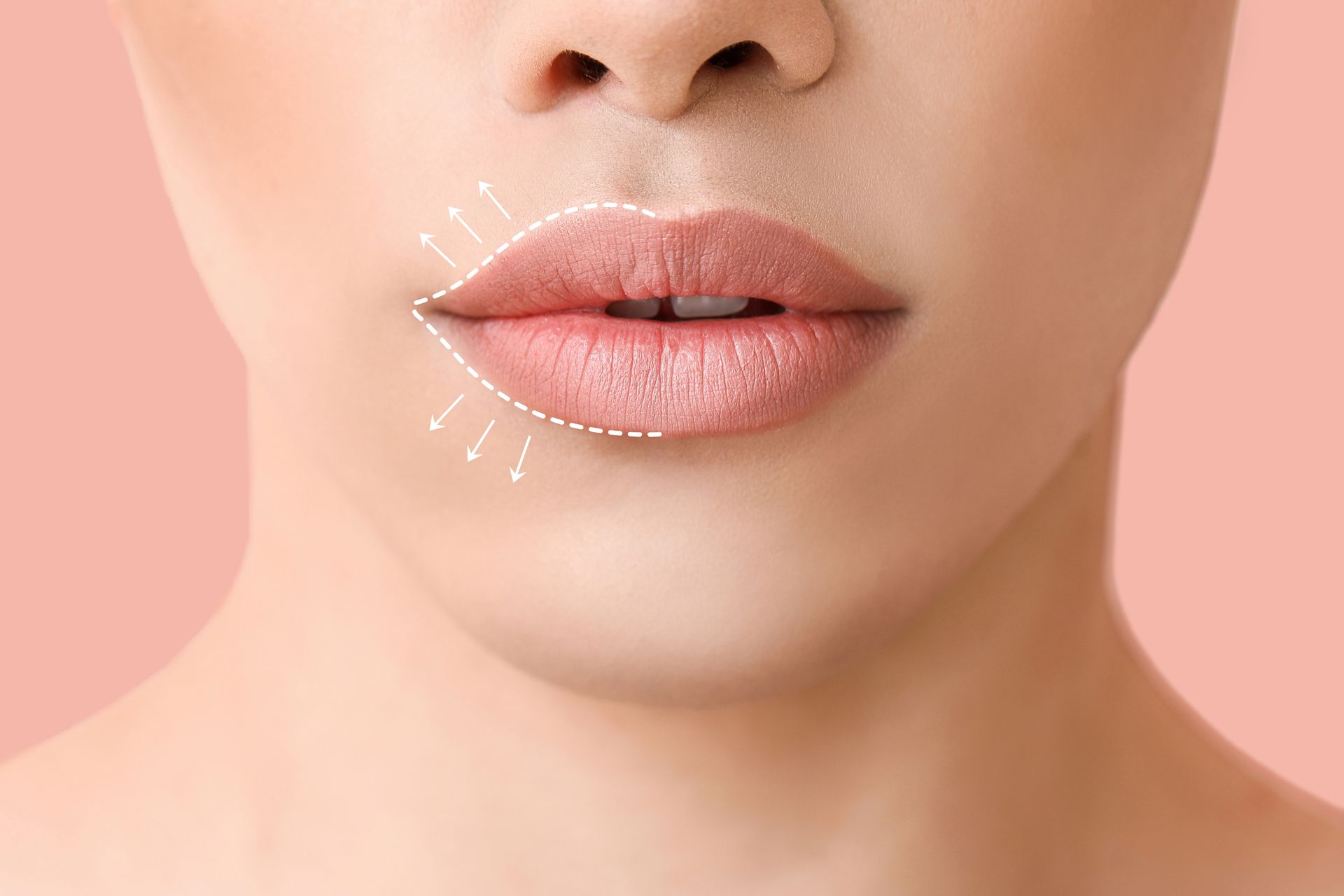 Close-up of lips with dotted lines and arrows indicating lip augmentation.