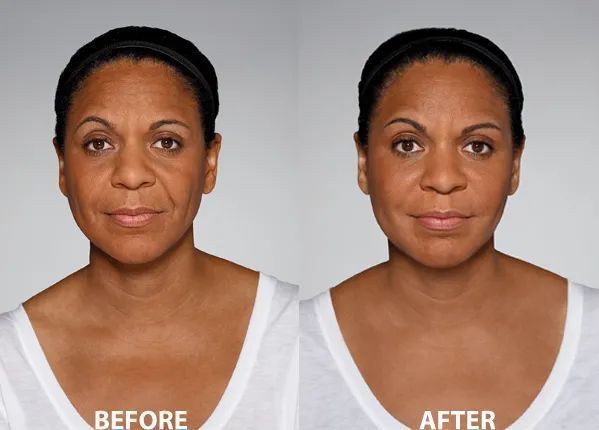 Side-by-side comparison: woman's face before and after cosmetic treatment, showing reduction in facial wrinkles.