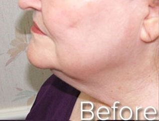 Profile view of a person's face and neck, with a double chin.