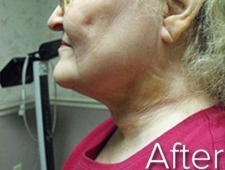 Profile view of a person's neck and chin.