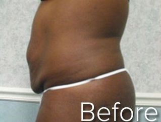 Side view of a torso with excess skin and fat; white underwear; 