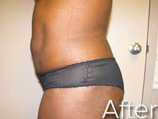 Side view of a torso in dark underwear, showing abdominal contour after surgery, with a scar.