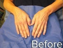 Hands of a person on blue surface before an unspecified procedure.