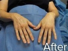 Hands resting on blue fabric, appearing smoother after a procedure.